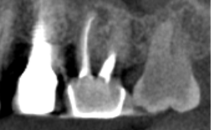 CBCT tooth 14