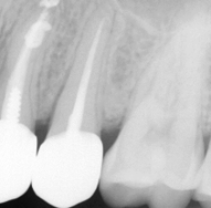Xray tooth 13