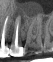CBCT tooth 13