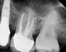 Xray tooth 14